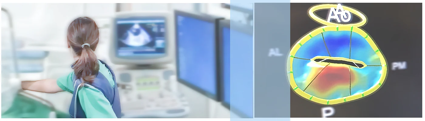 dioisofageio yperixografima 3d